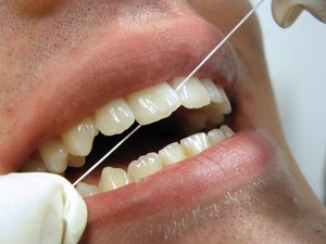Prophylaxe und professionelle Zahnreinigung